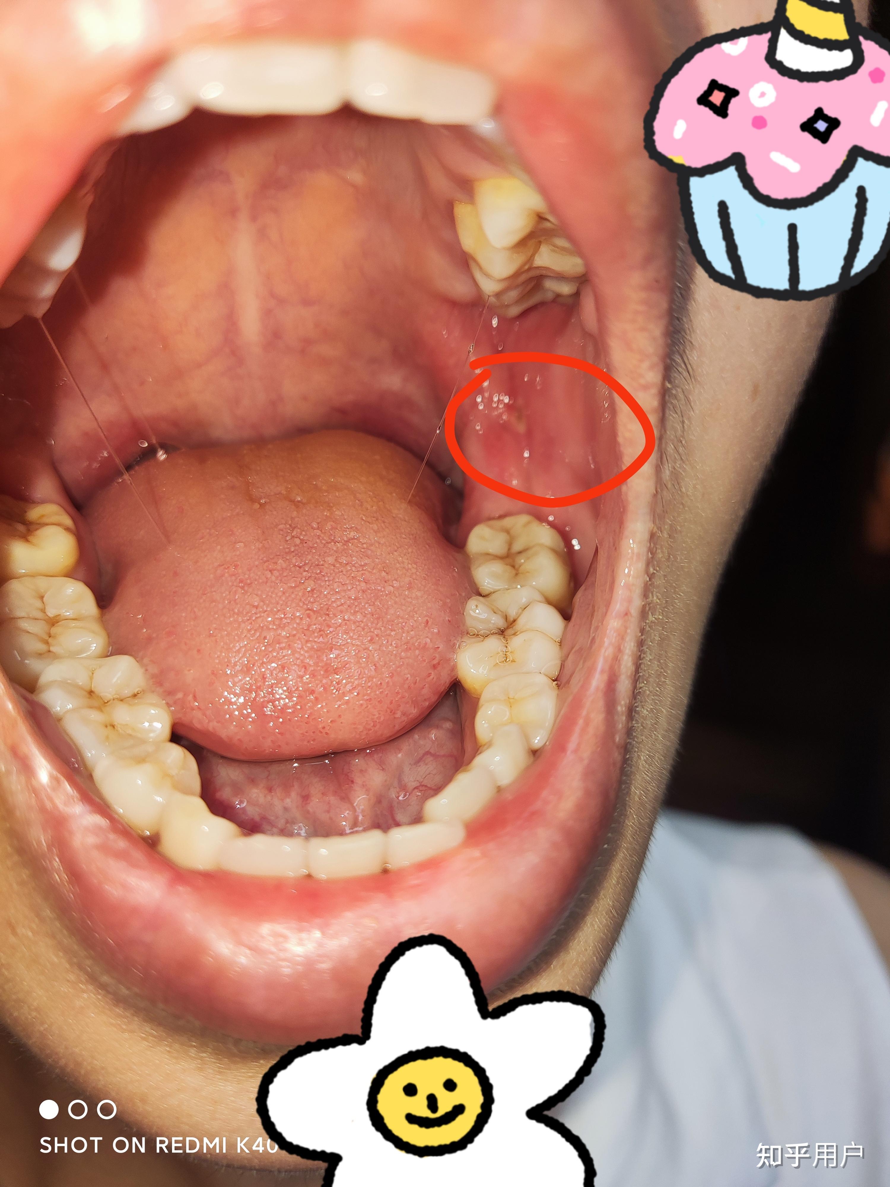 你们感觉口腔溃疡长在嘴里的那哪个位置最折磨人 ? - 知乎