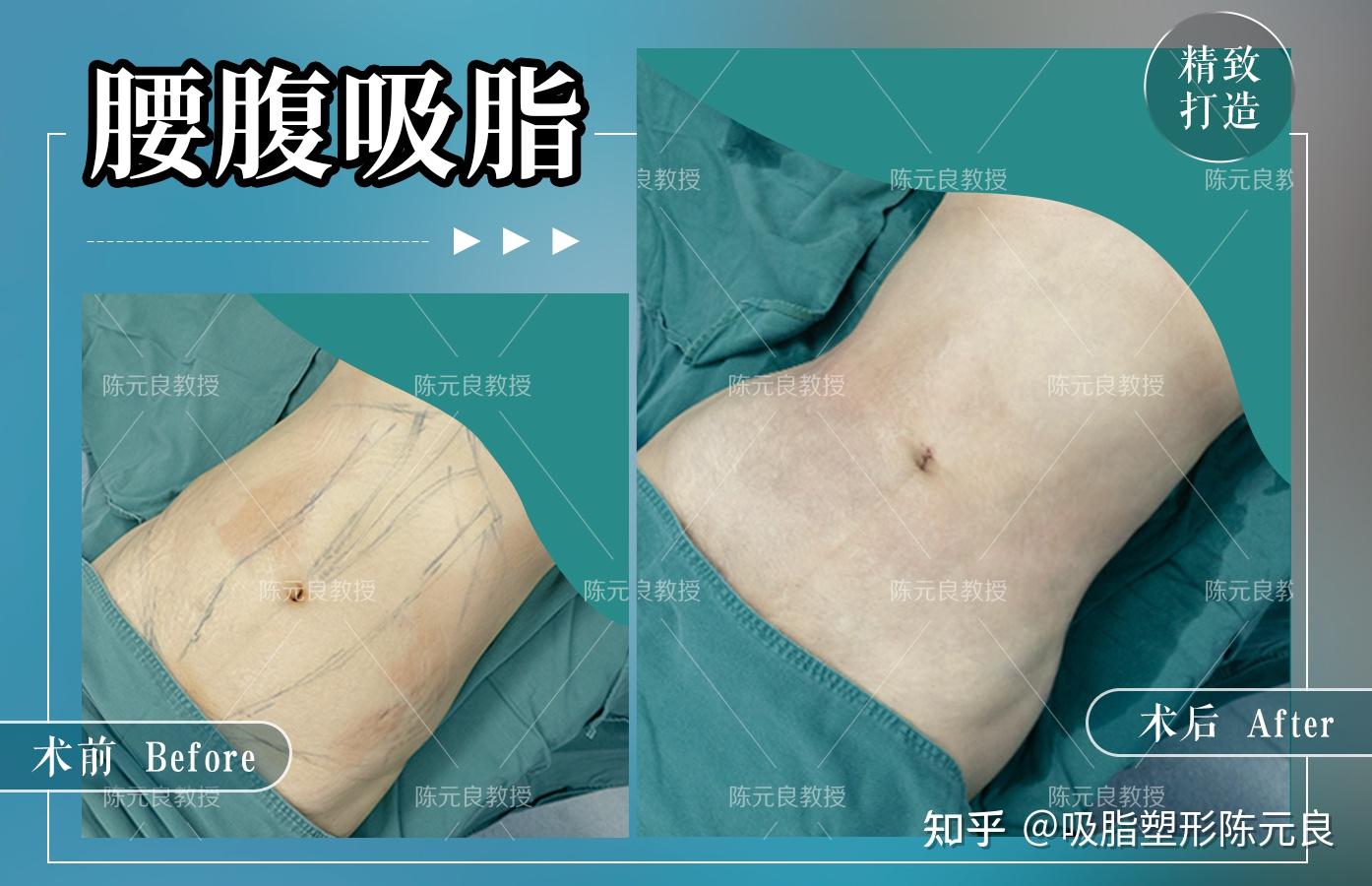 杭州哪个医生做吸脂好？主要是腰腹、大腿、面部吸脂领域的，最近天气凉爽，有考虑做吸脂塑形手术。 - 知乎