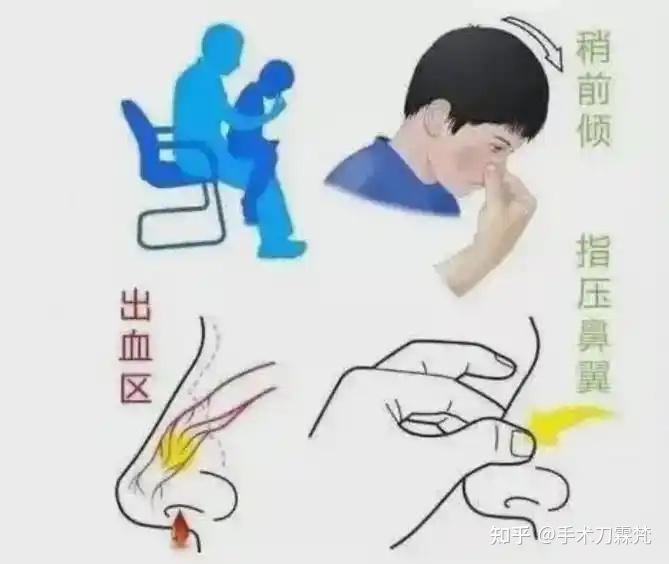 流鼻血(鼻出血、鼻衄)的家庭防治小妙招 - 知乎