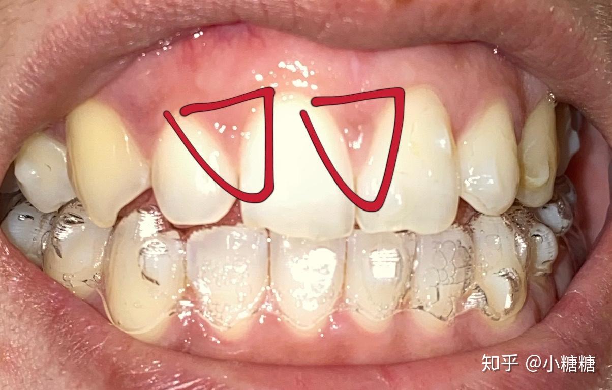 隐适美牙套压迫牙龈导致牙龈被压出一个大坑已经停止压