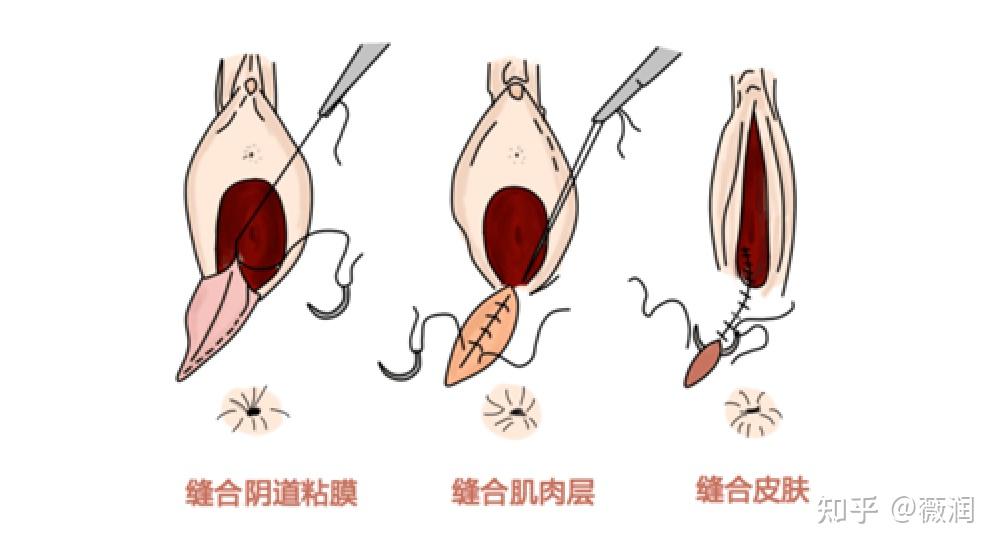 女人分娩侧切图片图片