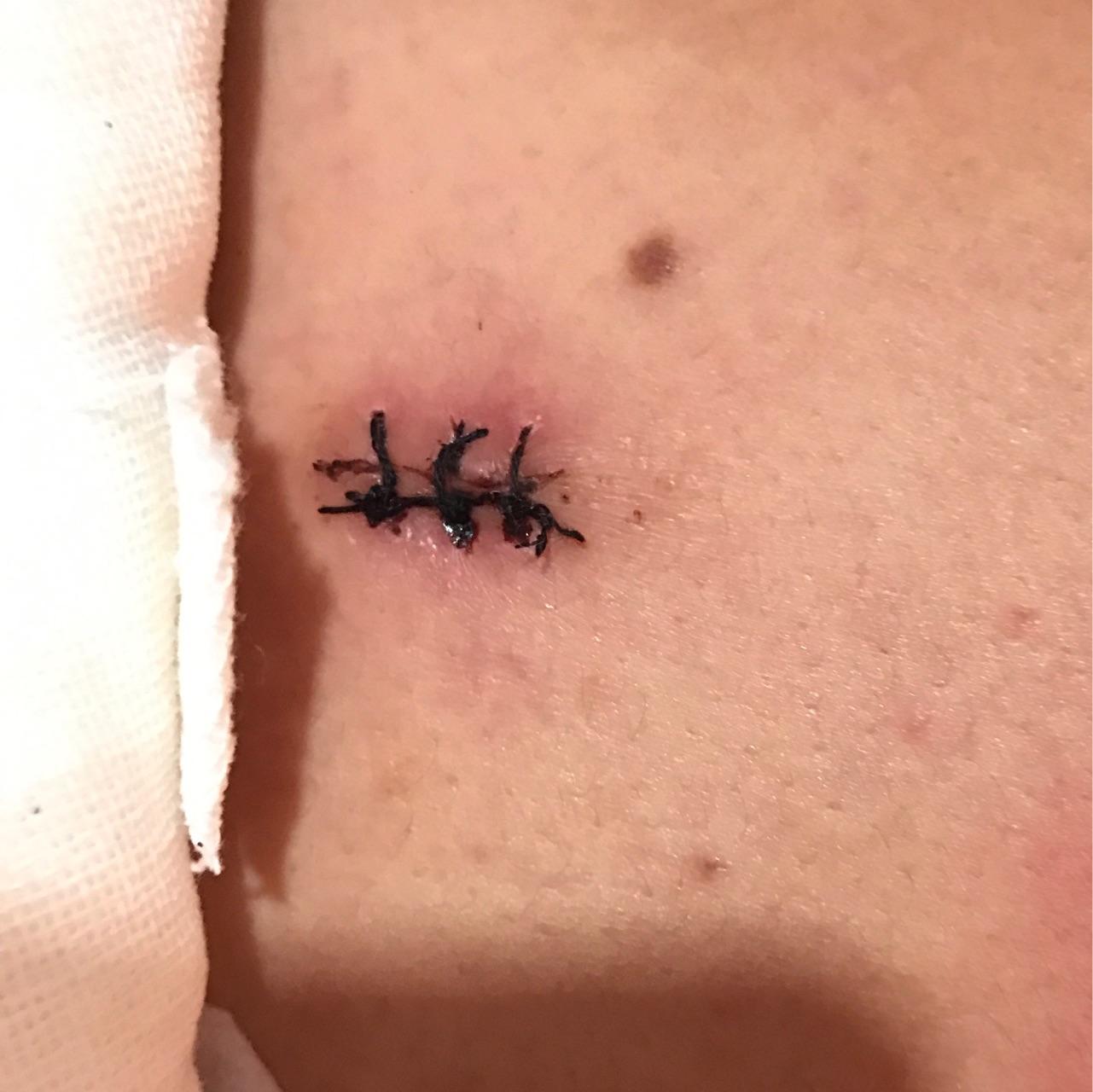 耳朵后面长了个包医生说是皮脂腺囊肿不想开刀有没有什么偏方能消肿