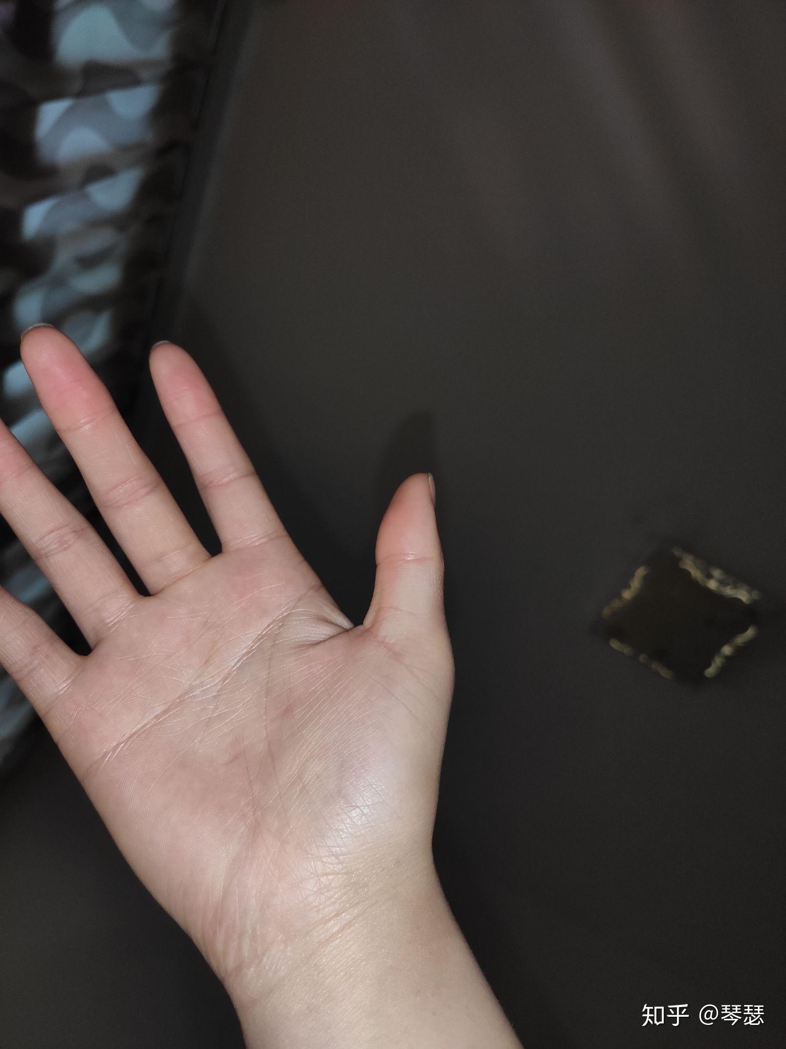 睡觉中经常会紧握住手成拳头状,醒后发现指甲掐的手心很深的印是怎么