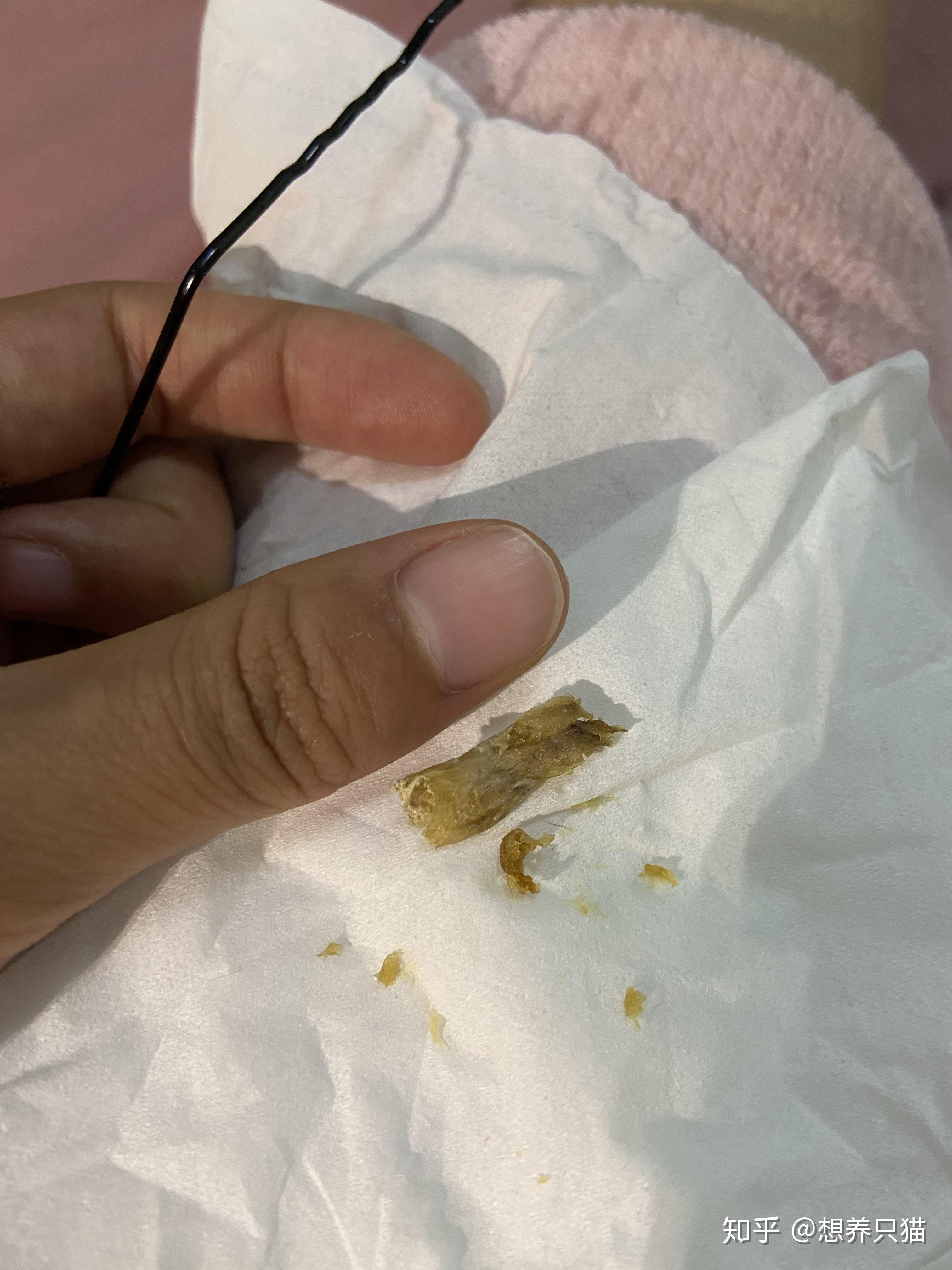 耳屎最大能有多大