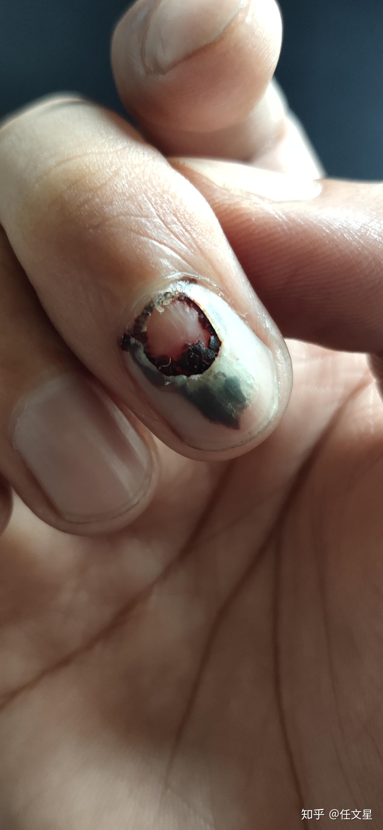指甲被车门挤伤 指尖全是淤血 怎么办? - 知乎