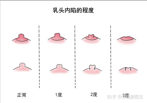 女性乳头正常外观裂开图片