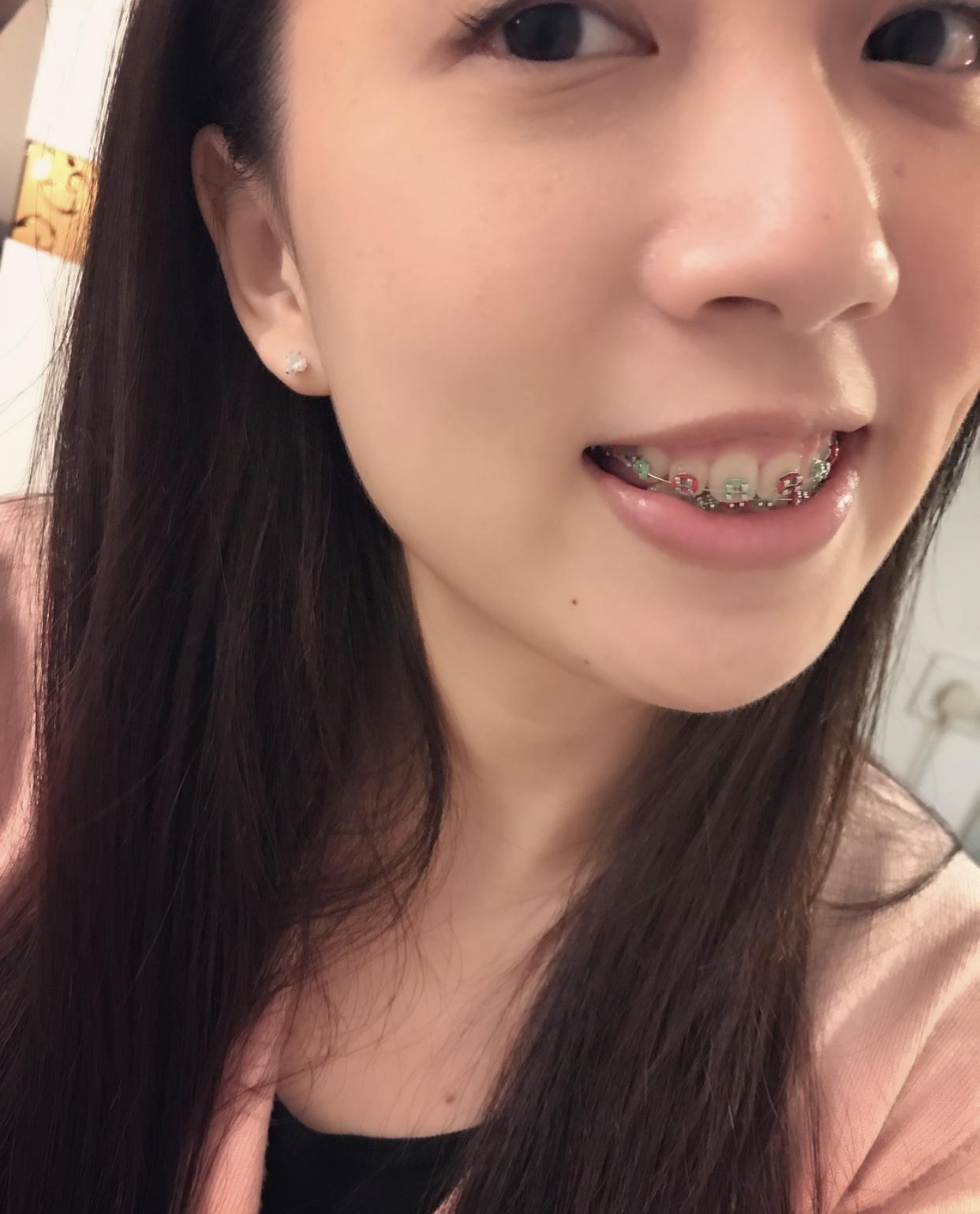 25岁开始箍牙是什么体验大钢牙也可以美美的