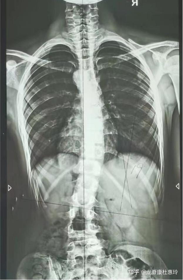 脊柱侧弯患者参加3天强化班训练后,中线和剃刀背基本回归正常! - 知乎