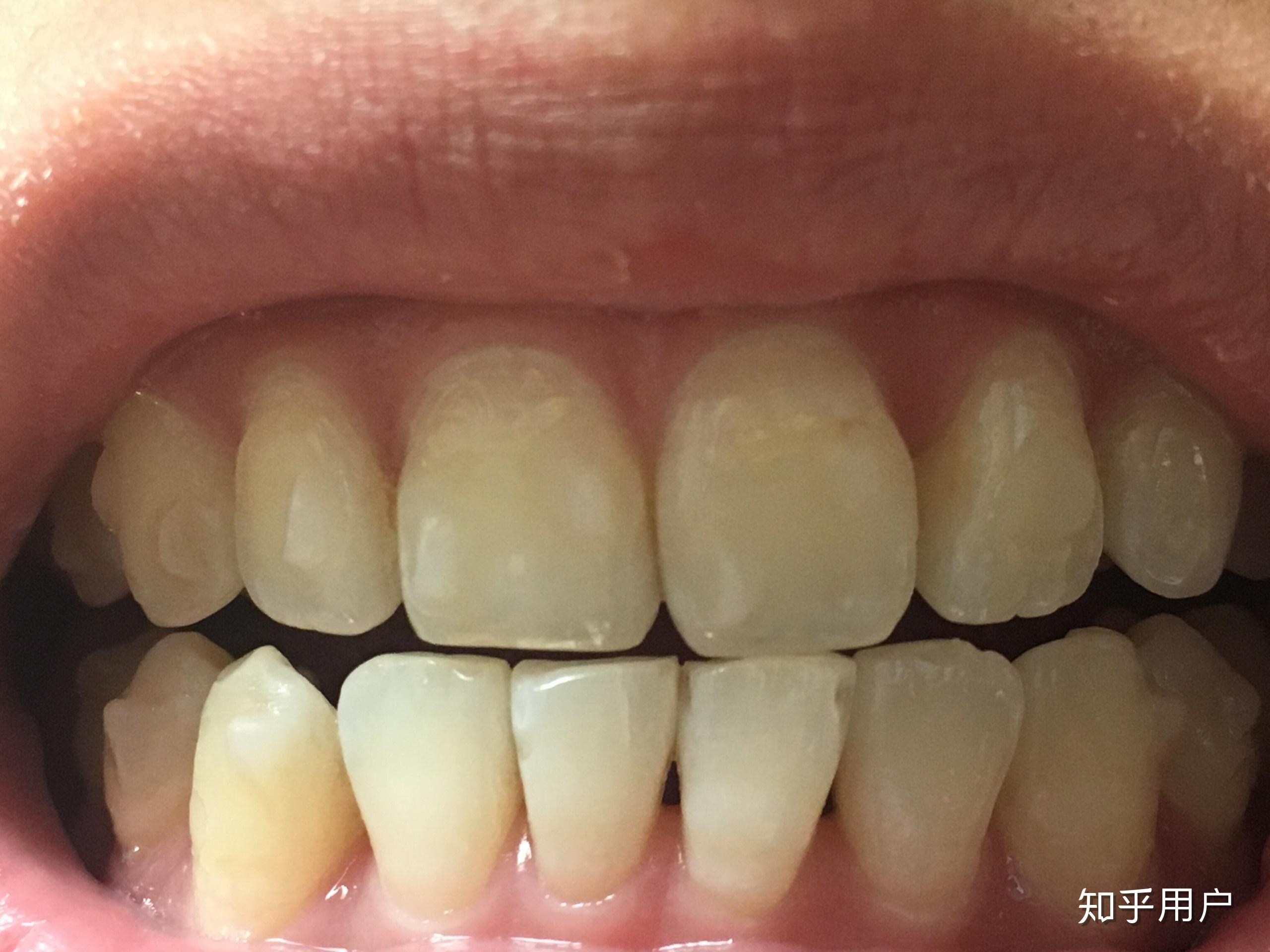 整过牙的妹子们会因为黑三角后悔吗? - 知乎