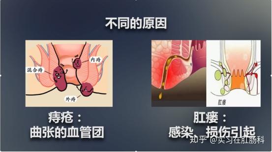 肛裂和肛瘻和痔瘡怎麼分辨