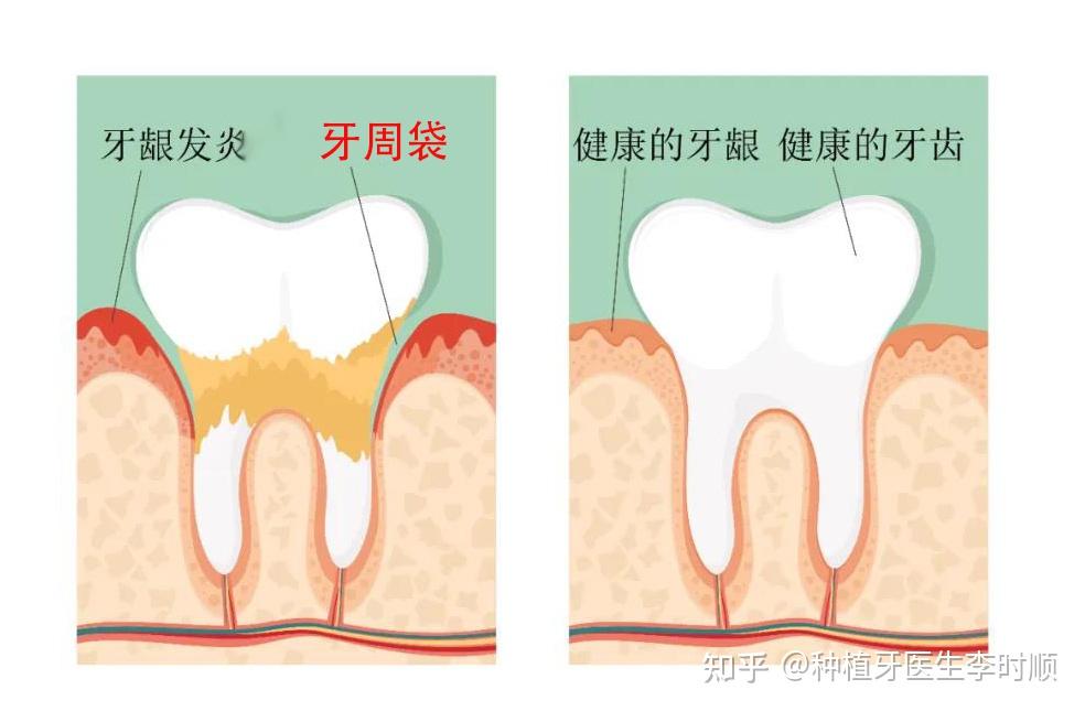 牙周炎龈下刮治是否有必要?利弊如何?
