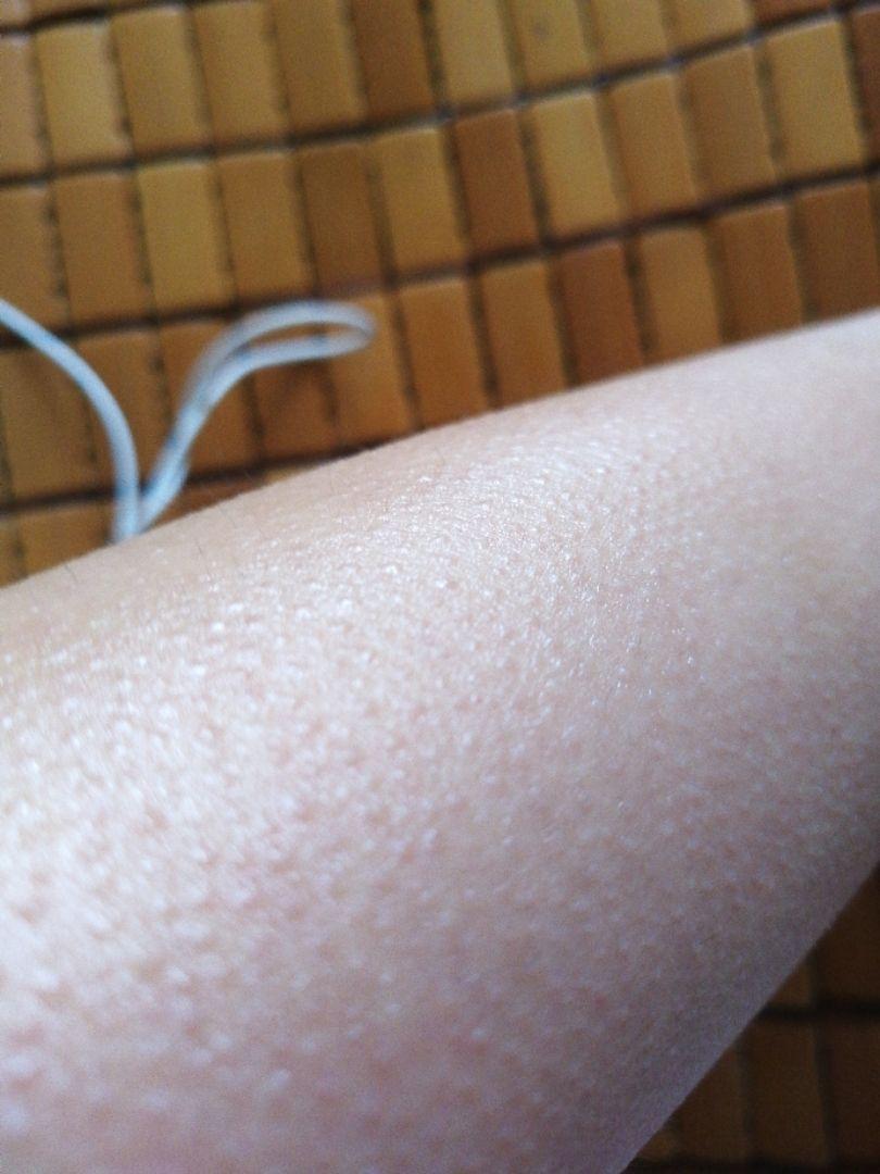 毛囊角质化鸡皮肤是否无法改善