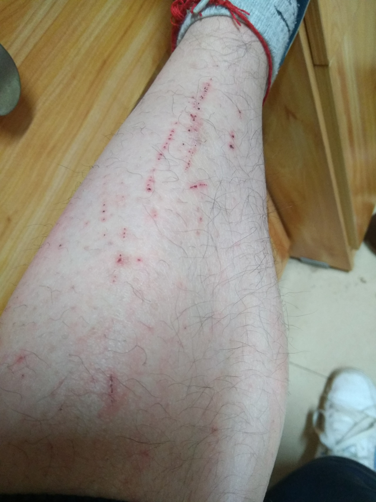 想请问为什么小腿无缘无故长血痂