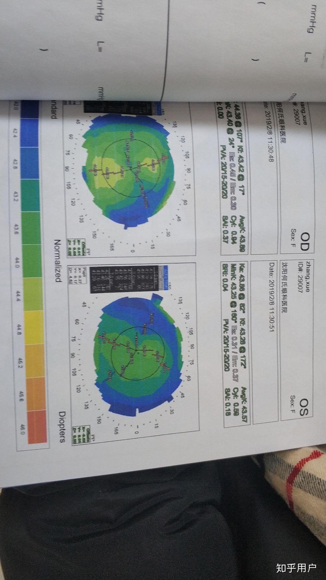 請大神看一下角膜地形圖是不是不規則散光晚上看東西上下重影