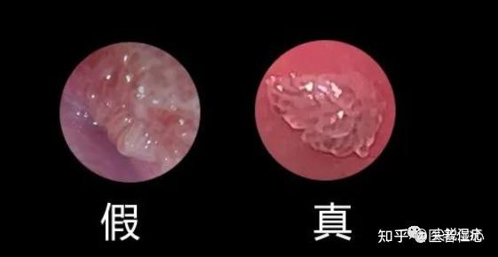 怎么辨别真假湿疣
