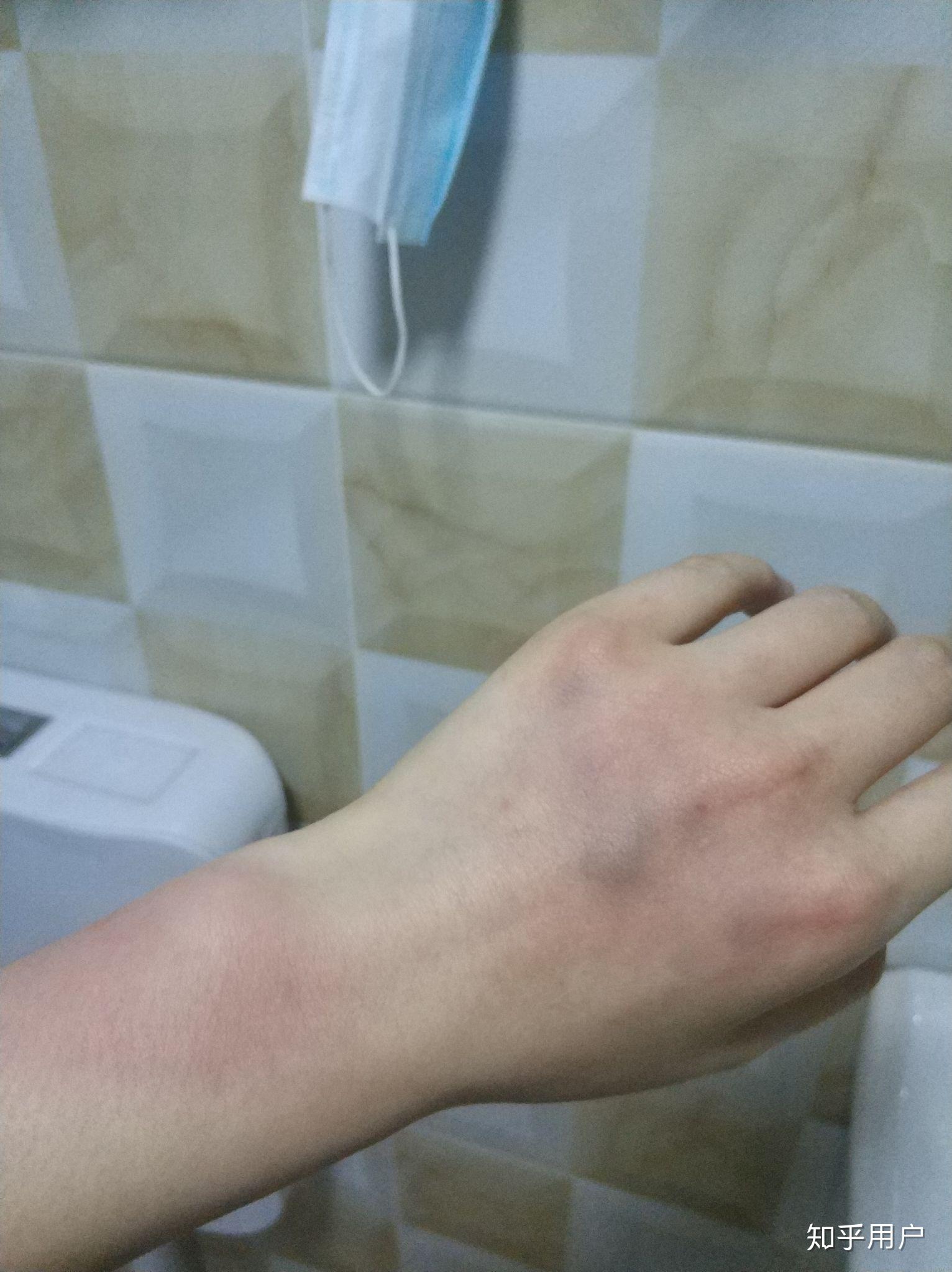 手指背面血管被砸受伤,手放下就慢慢肿胀,举起半天就慢慢平缓一些,但
