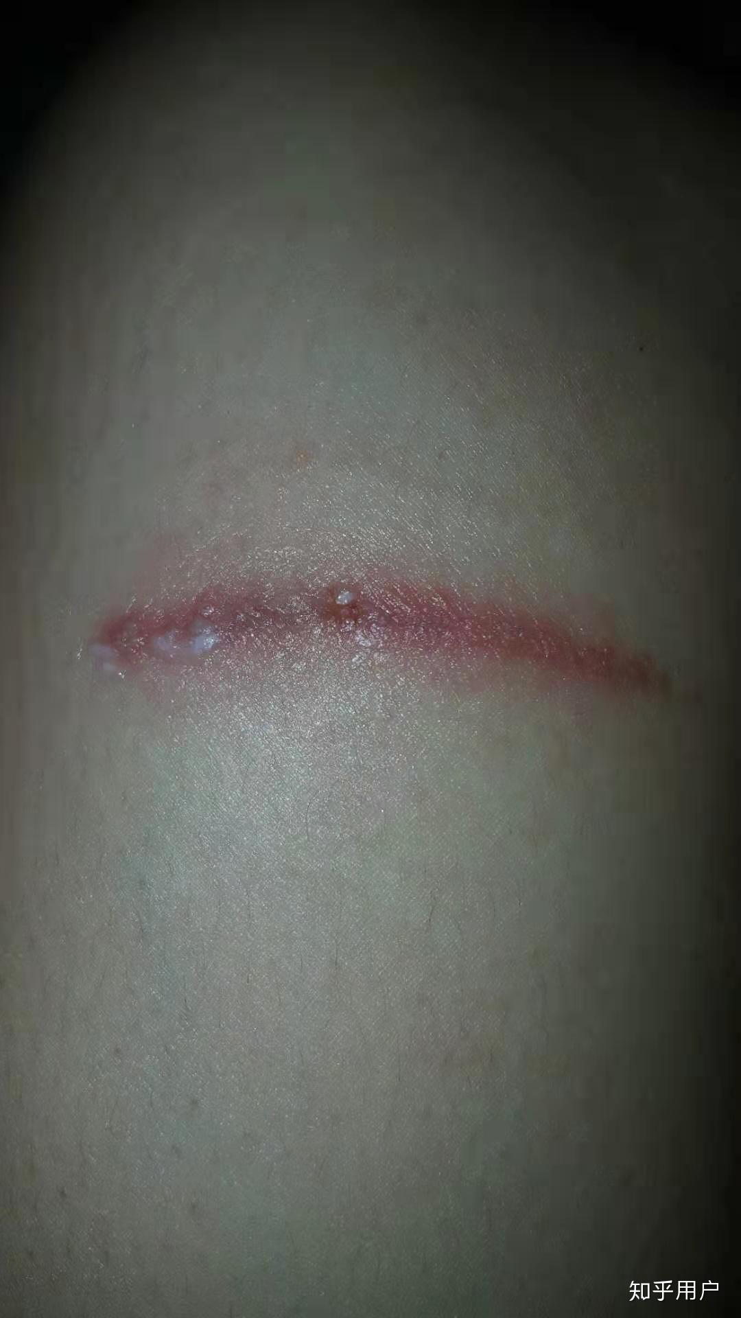 隐翅虫造成的伤口有什么特点