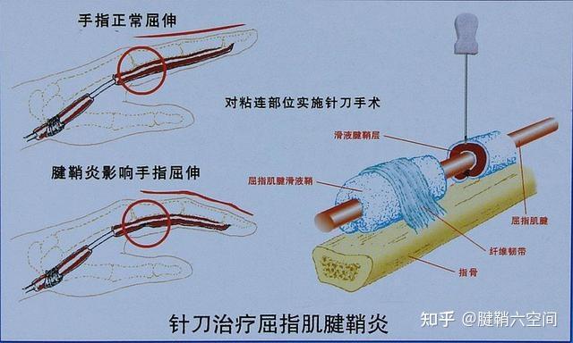 带你了解什么是小针刀疗法 - 知乎
