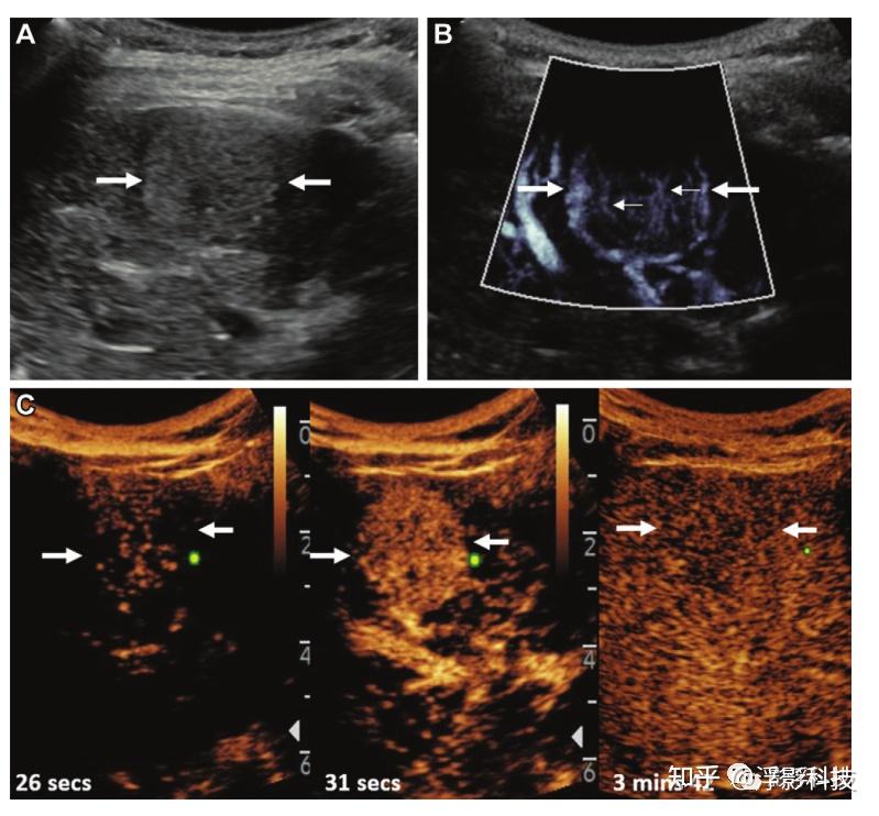 2022年第83期(Radiology): 微血管血流成像:临床应用现状和前景 - 知乎