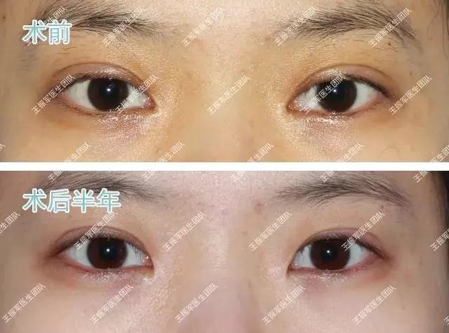 内眼角修复圆钝案例集锦