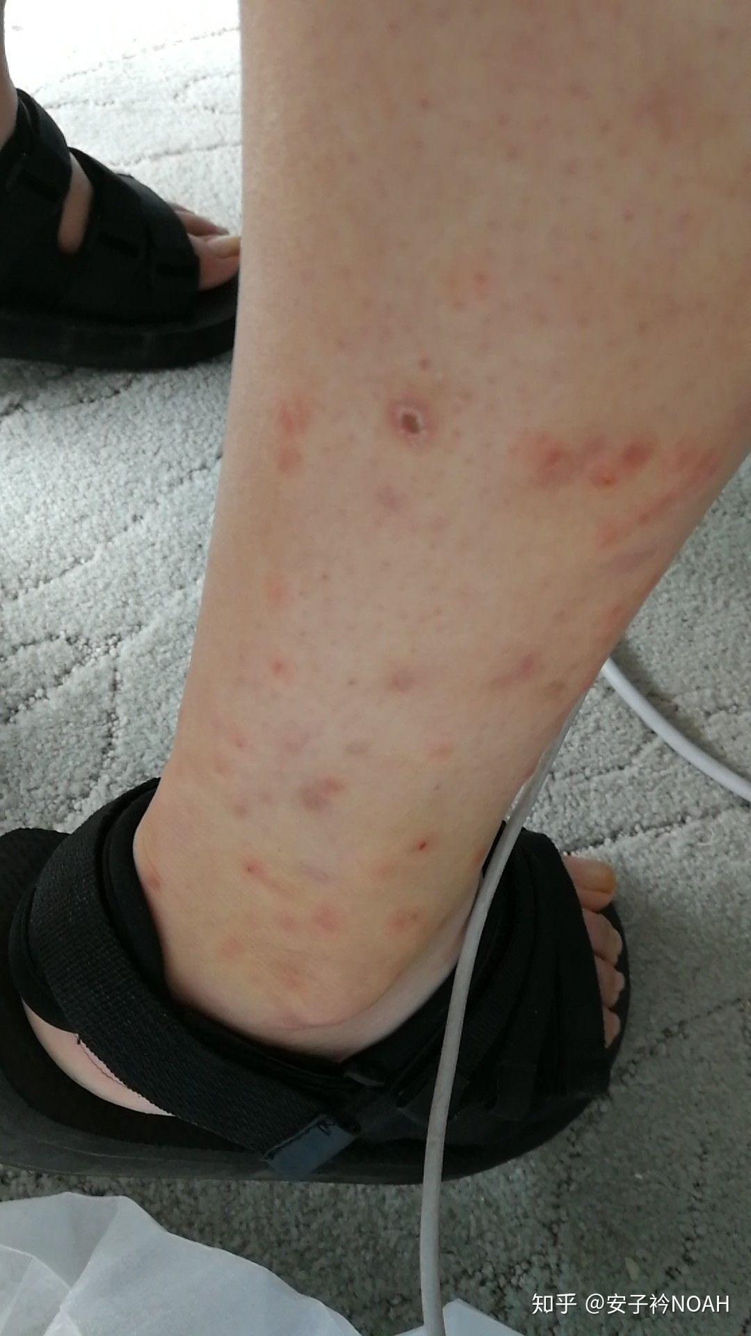 被蜱虫叮咬后应采取怎样的应急措施? - 知乎