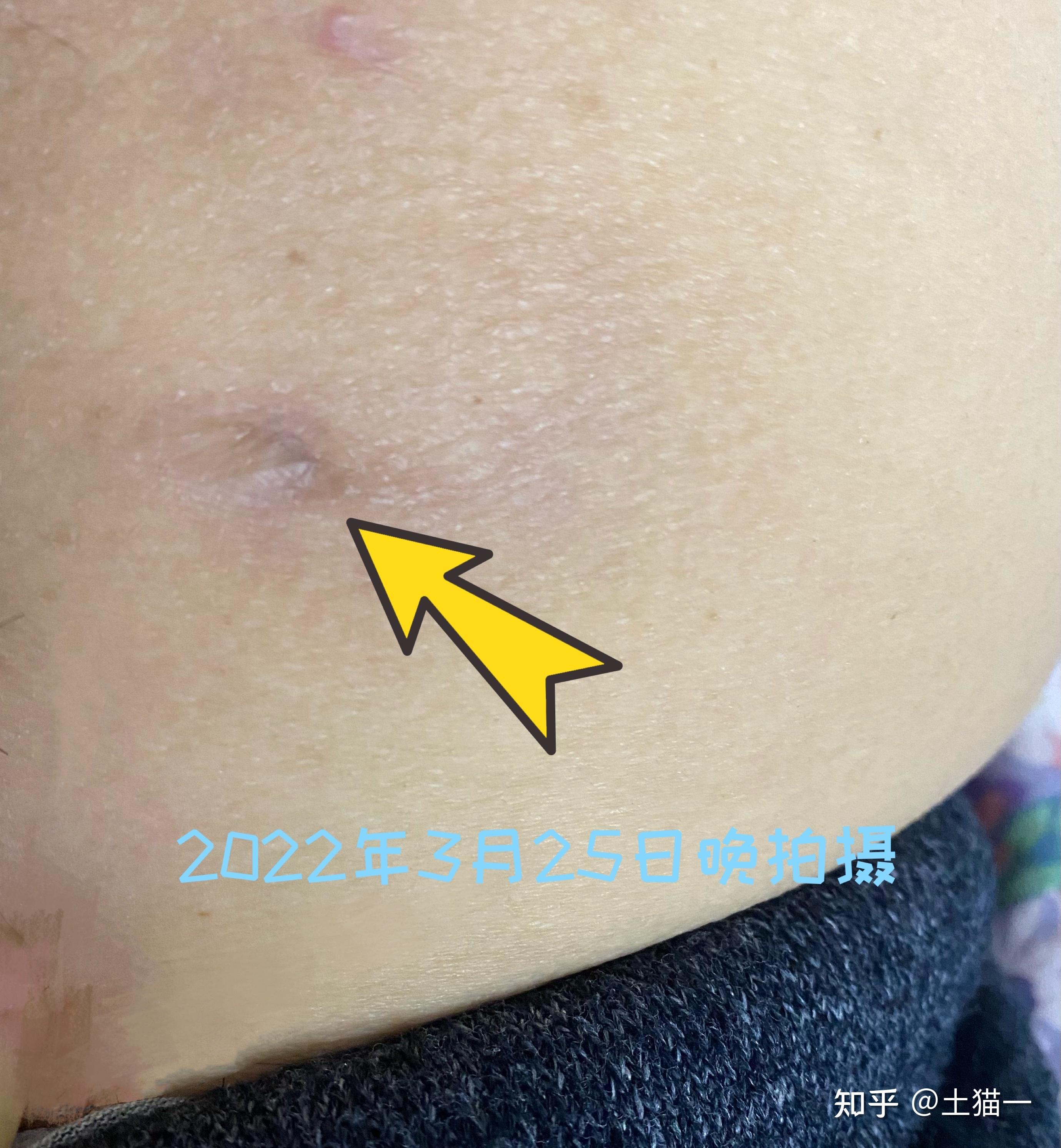 坐板疮 怎么治疗呢?已经好长时间了