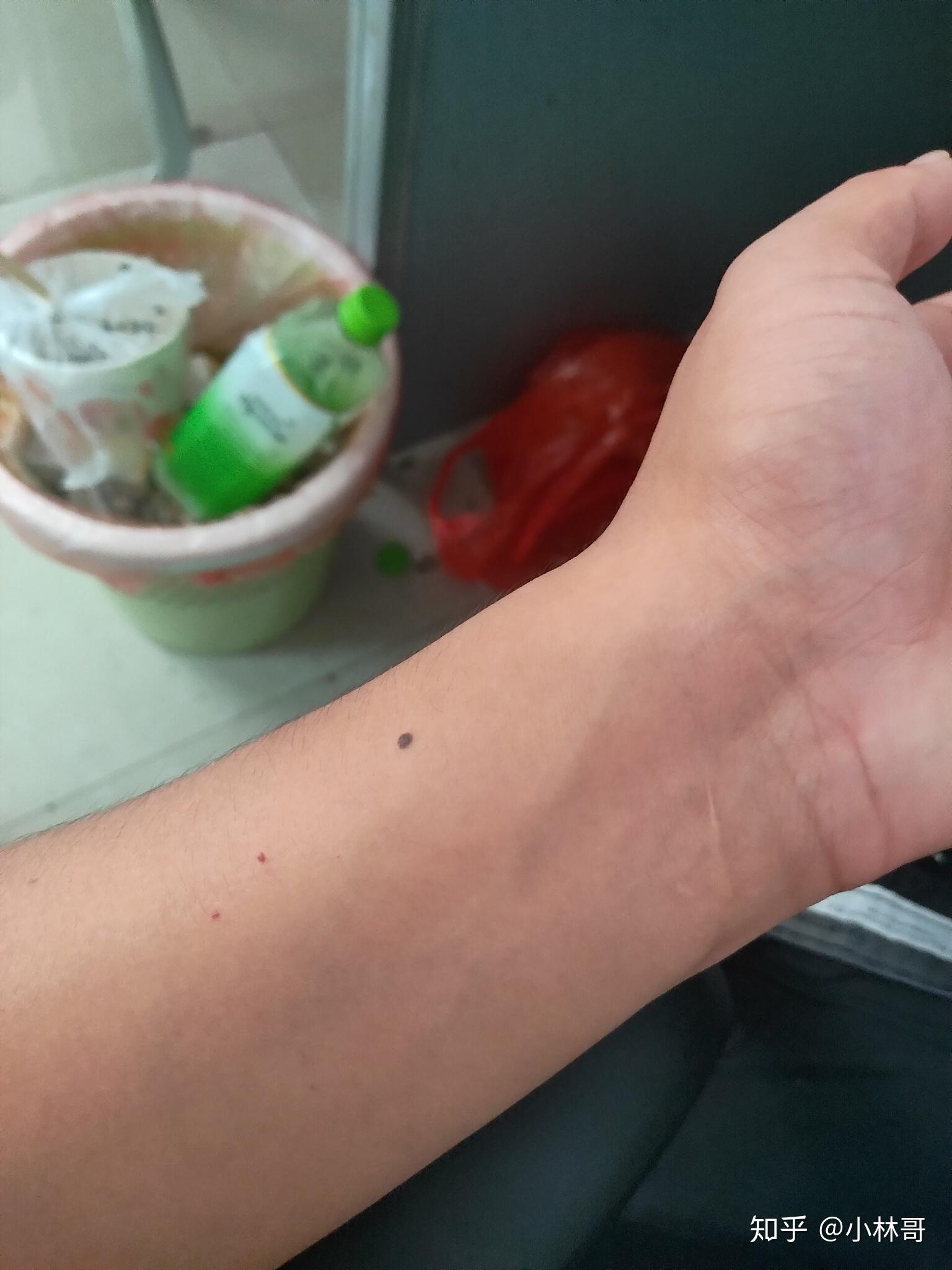 手腕两个小红痣会不会是再续前缘