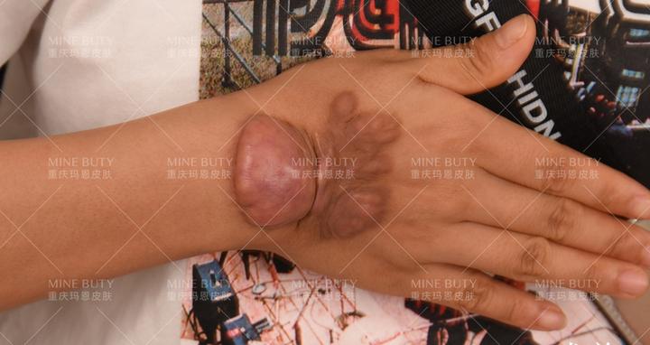 疤痕疙瘩在中医上为什么被称为"蟹足肿"?