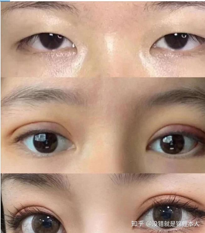 上海割双眼皮