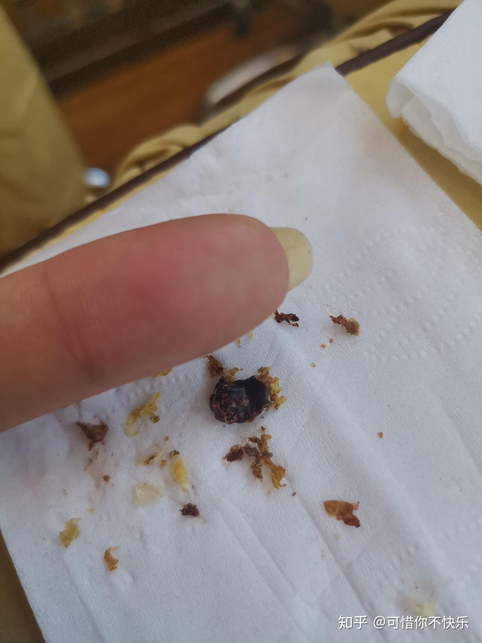 耳屎最大能有多大