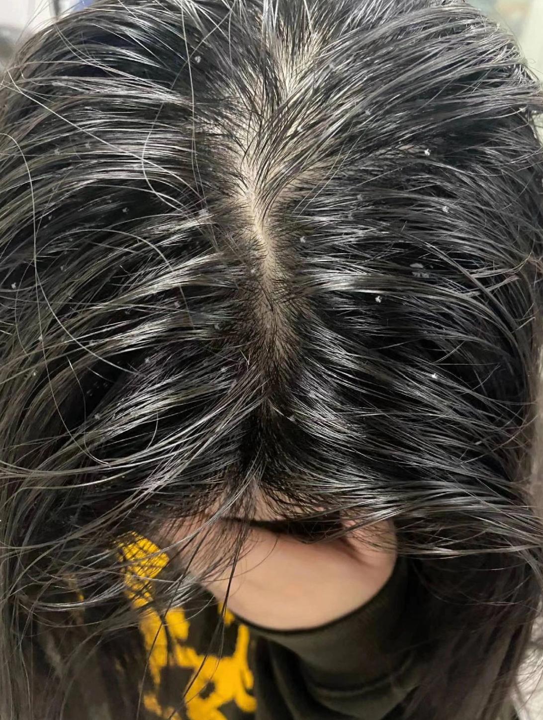 头皮屑特别多是什么原因?