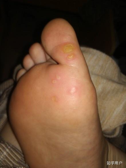 脚上长病毒疣怎么治?