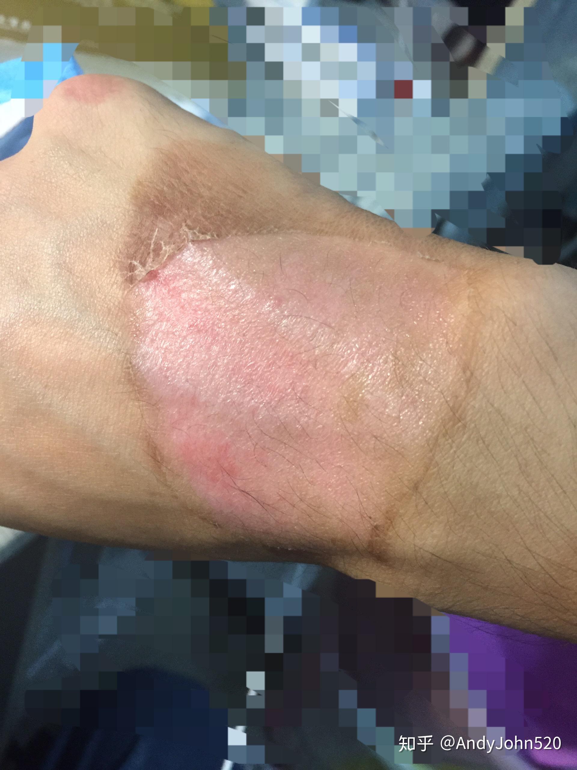 手被开水烫伤了怎么办