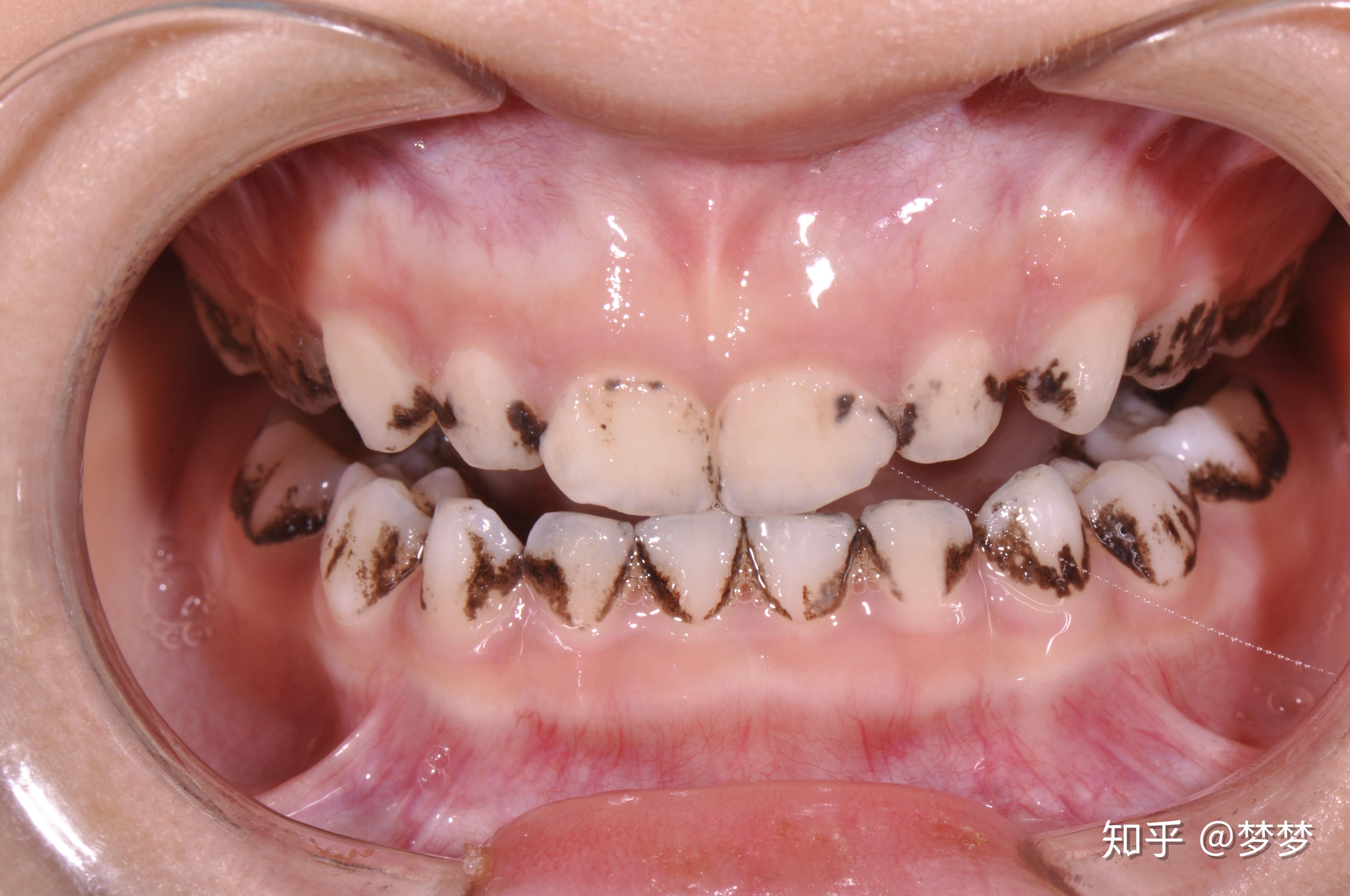 三岁宝宝的牙齿黑怎么办?