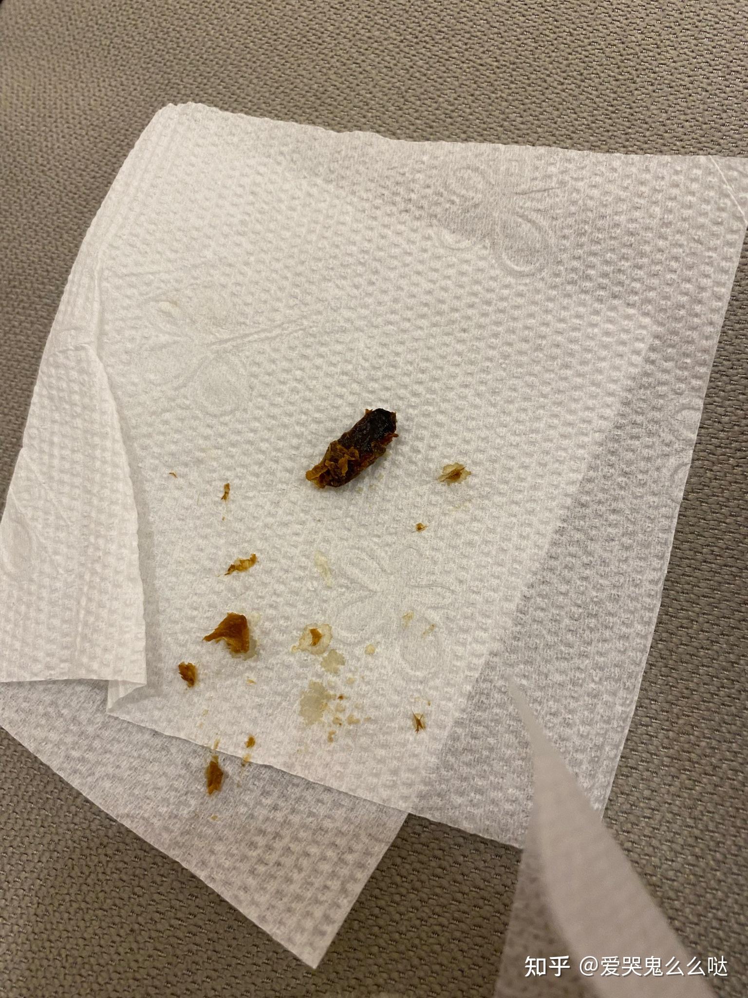 耳朵里长硬耳屎耵聍是什么感受