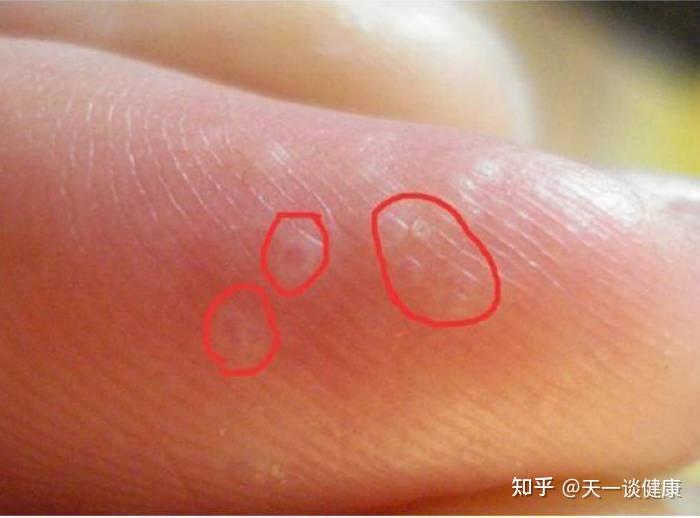 一到秋天转冬天的时候,手掌就呈现红色的斑块,会痒,摸起来也比较硬