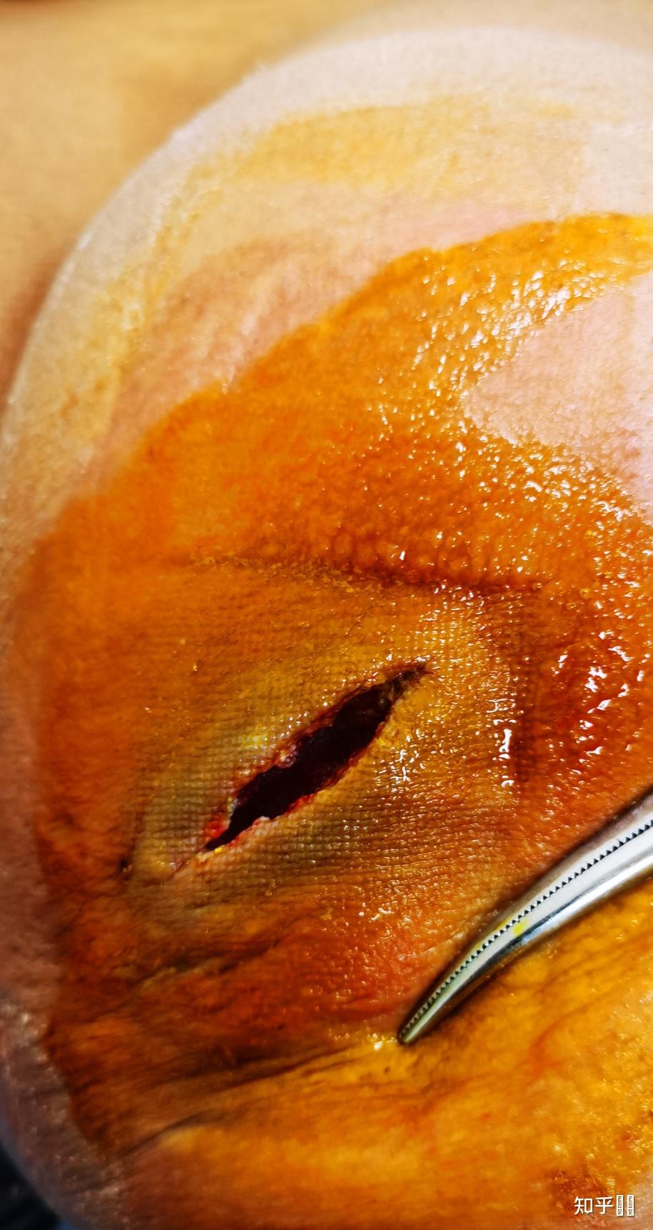 臀部有个硬块皮脂腺囊肿可以不手术治疗吗