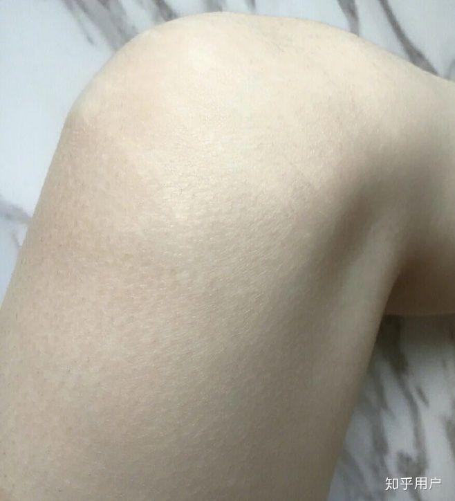 屁股上有生长纹会不会被嫌弃