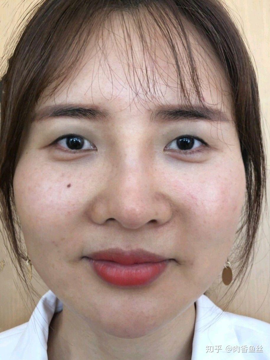 肉鼻子有什么解决的办法? - 知乎