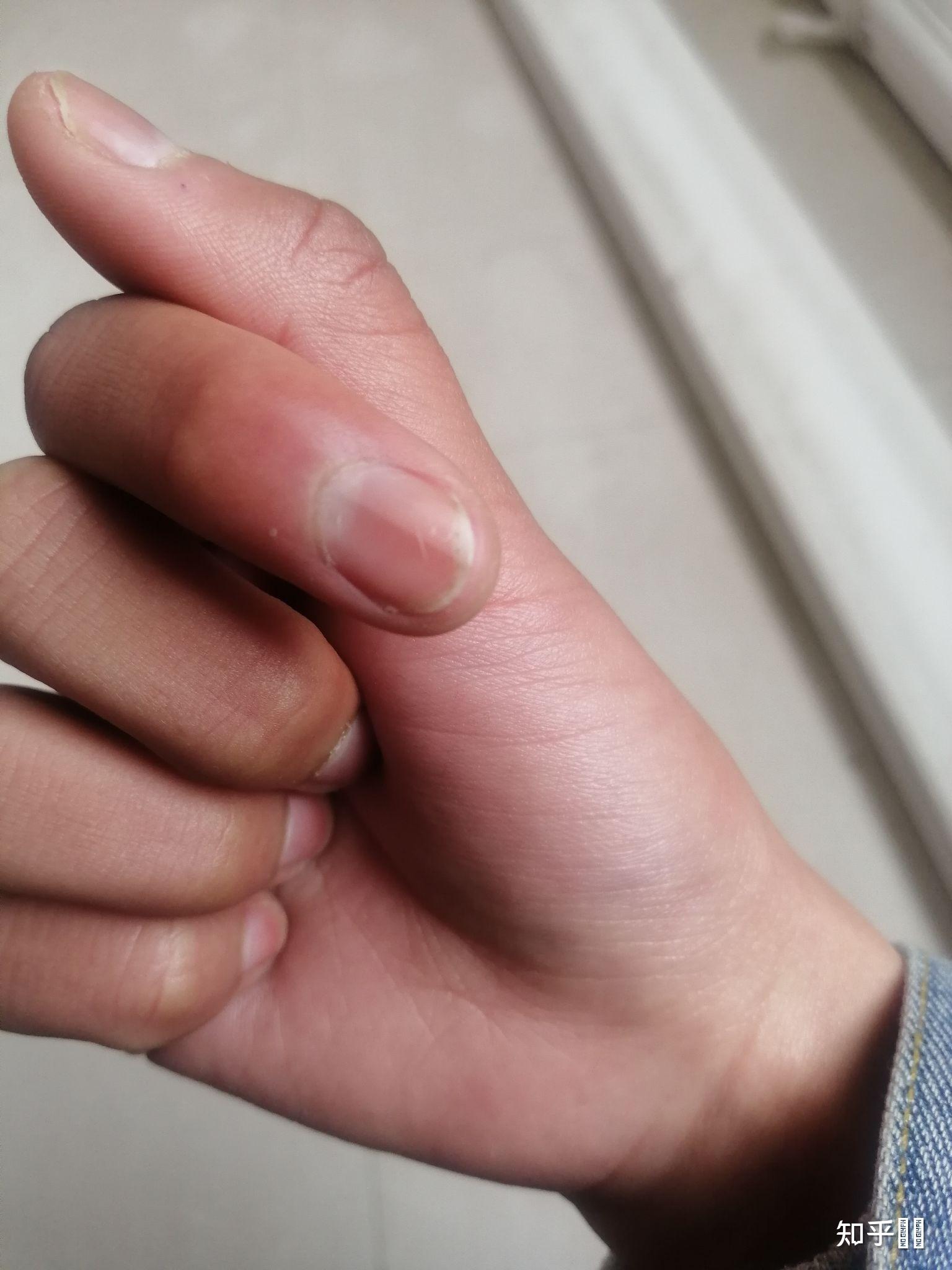 左手食指有一条黑线是怎么回事