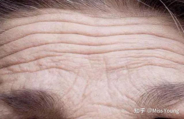 面部皱纹的分类和形成原因是什么?如何科学除皱? - 知乎
