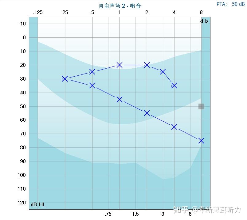耳鸣科普（一）|单侧听力损失伴耳鸣该怎么办 - 知乎