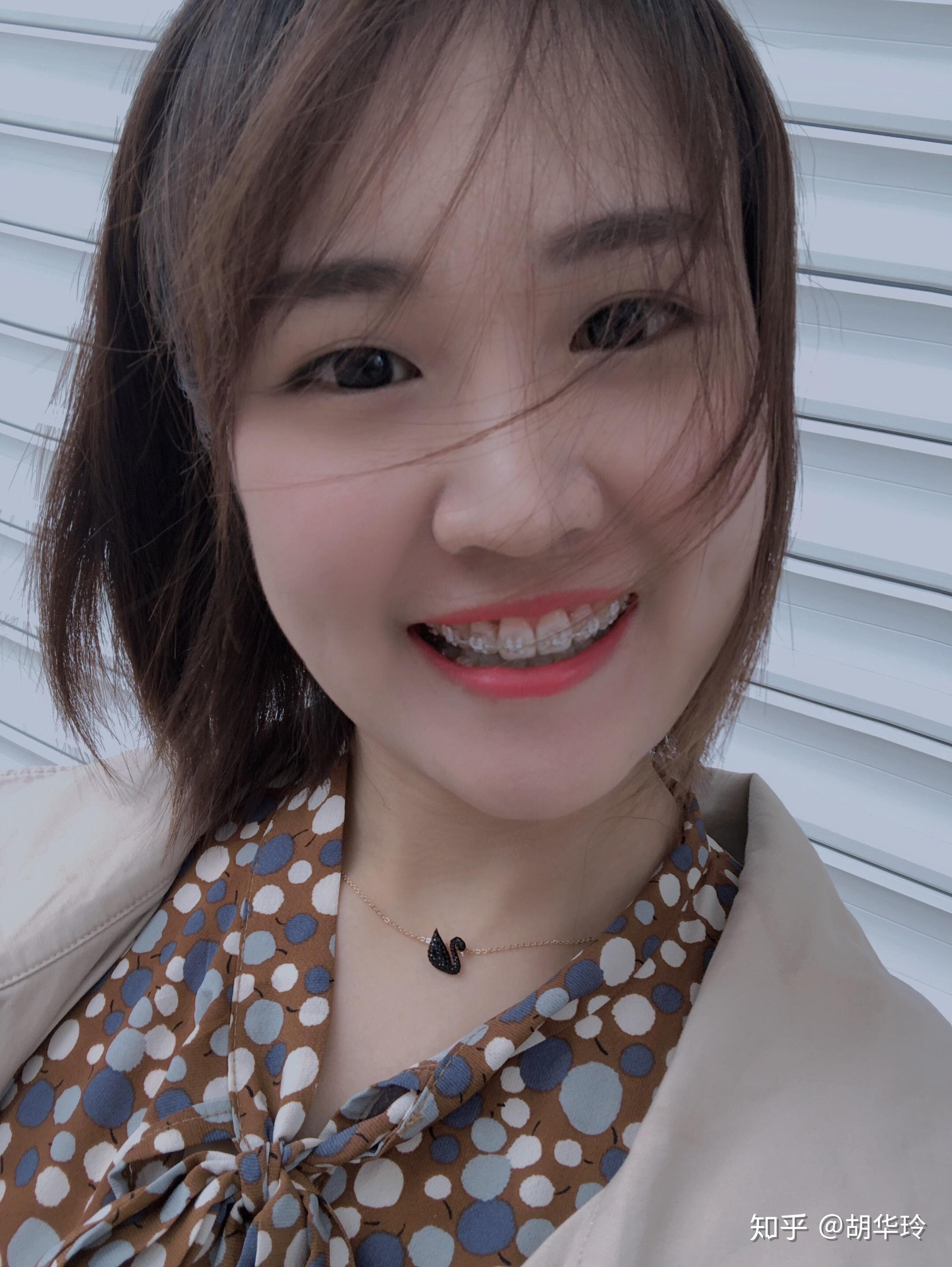 女生矫正牙齿后变美是怎样的体验?