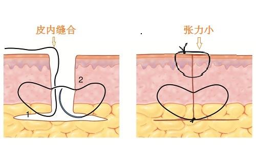 什么是美容缝合?