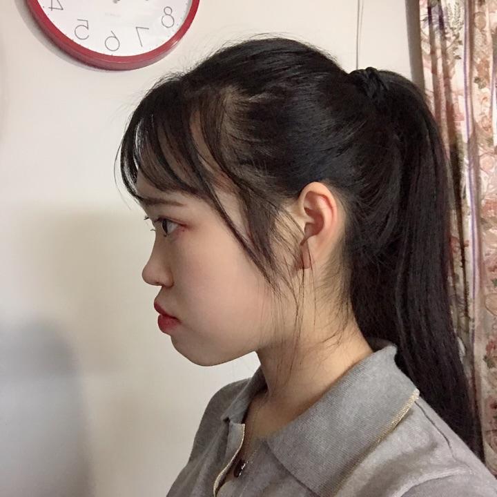 龅牙凸嘴怎么改善侧脸? - 知乎