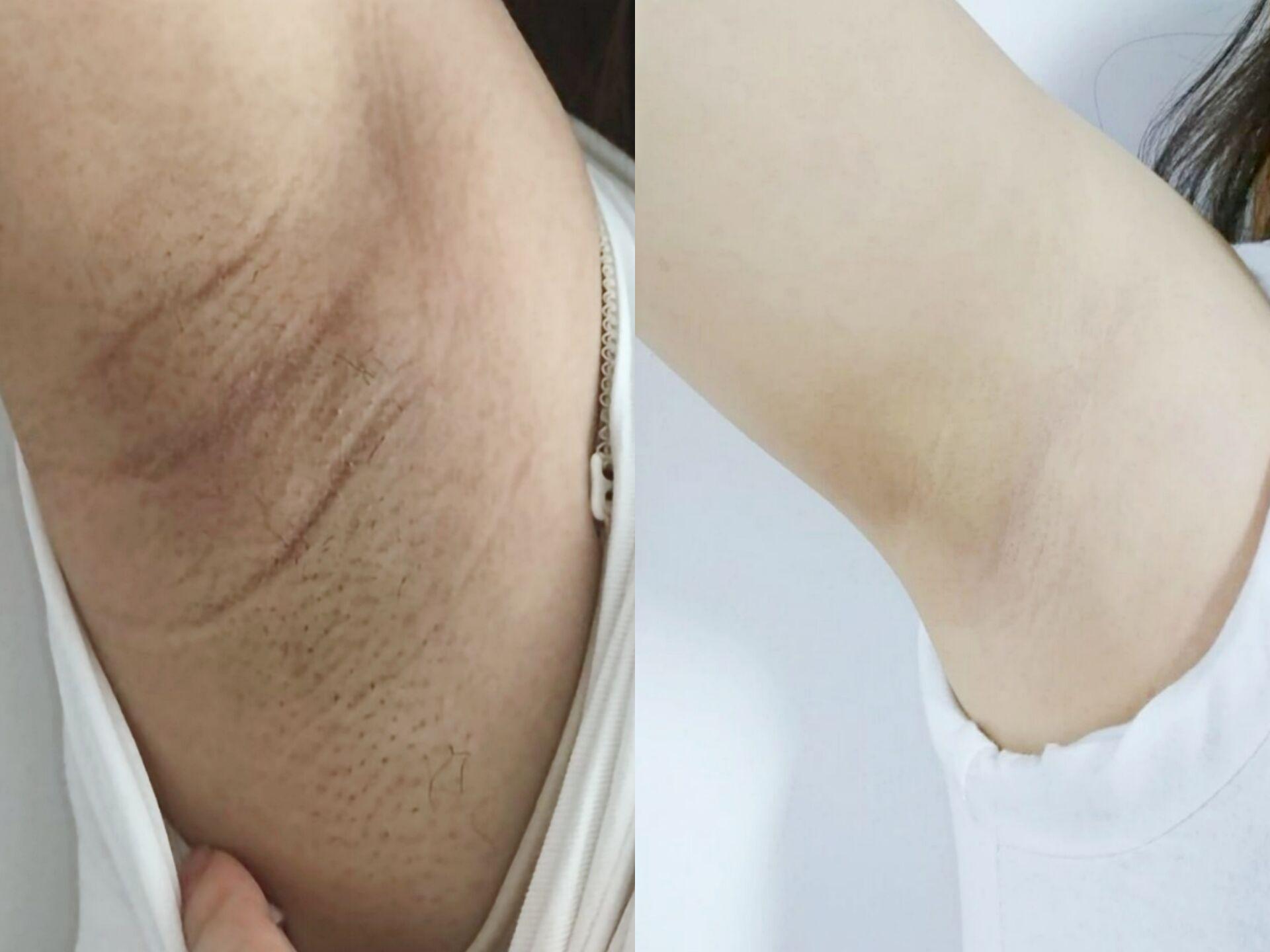 腋毛拔除后腋下大面积发黑怎么办? - 知乎