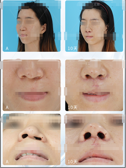 國內哪位專家做唇裂鼻修復很厲害
