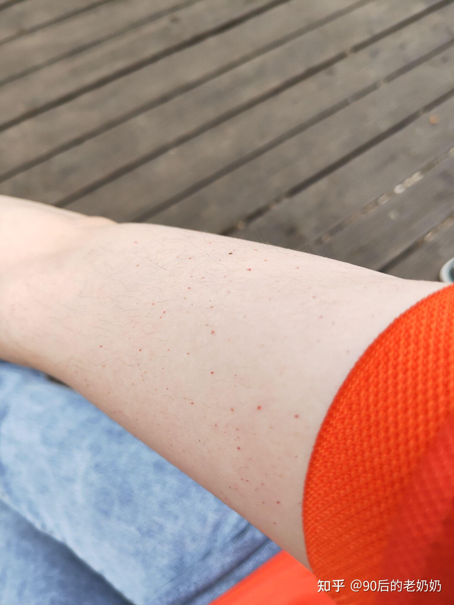 手臂上很多小红点是怎么回事需要注意些什么之前入职体检的时候所有