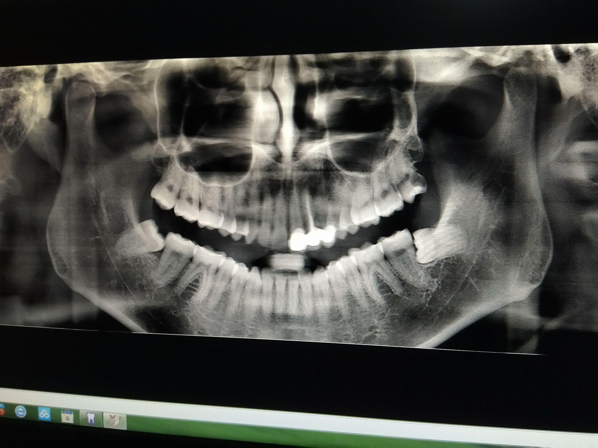 如何判断大牙有没有换过?