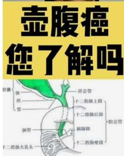 壶腹周围癌有哪些显著的症状?